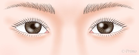 下眼瞼拡大術（たれ目形成）イラスト